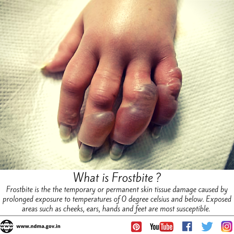 What is frostbite? – Temporary or permanent skin tissue damage caused by prolonged exposure to temperatures of 0 degree Celsius and below
